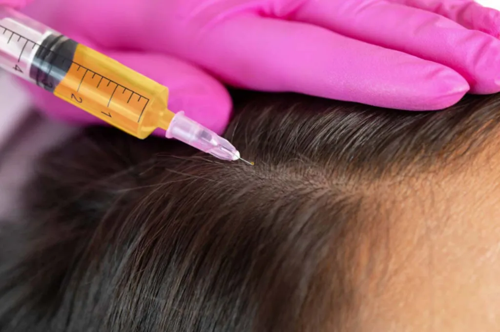 Saç Ekimi Sonrası PRP Tedavisinin Önemi